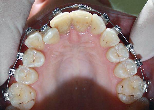 ортодонтичне, Ортодонтичне лікування, «Амарант»  Клініка естетичної стоматології Dr.Alexey_Kukharevich